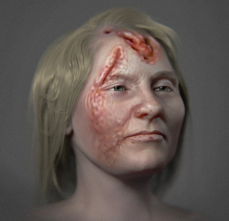 تقريب سيسيرو مورايس  لوجه امرأة من القرن السادس عشر مصابة بمرض الزهري الثالثي (سيسيرو مورايس)