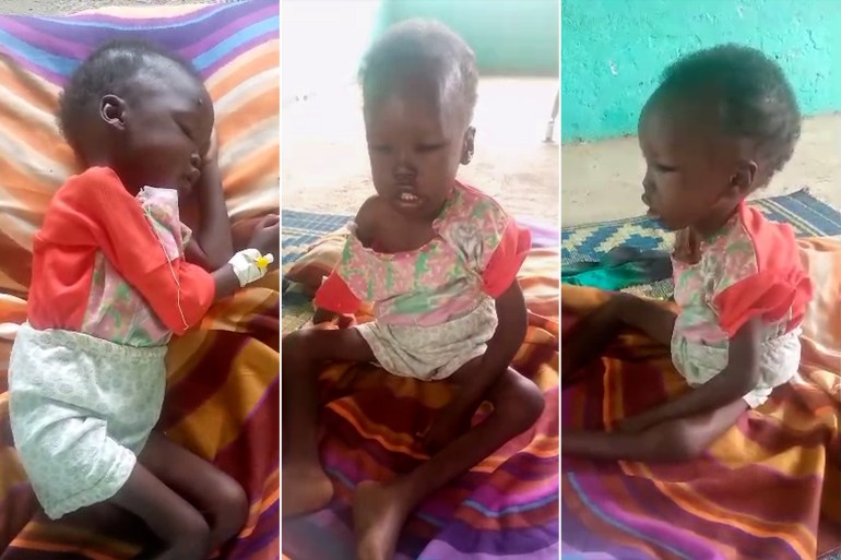 أطفال مصابون بسوء التغذية الدلنج