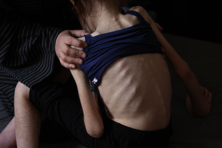 Shuruq Ayyad shows off the protruding ribs of her 12-year-old daughter Rahaf at a school-turned-shelter in al-Rimal in central Gaza City on May 4, 2025.