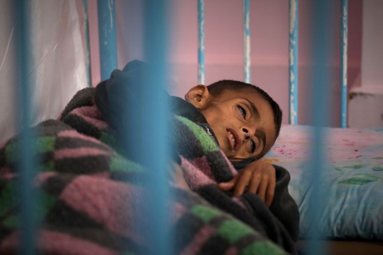 Osama al-Raqab, 5, whose mother says his cystic fibrosis has worsened since the start of the war due to the lack of meat, fish and enzyme tablets to help him digest food, is being treated at the malnutrition clinic in Nasser hospital, Khan Younis, Gaza, on Thursday, May 1, 2025. (AP Photo/Abdel Kareem Hana)