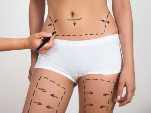 تجربتي مع عملية شفط الدهون في الرياض بمركز إنفيلد رويال سعودية: رحلة التغيير والتحول