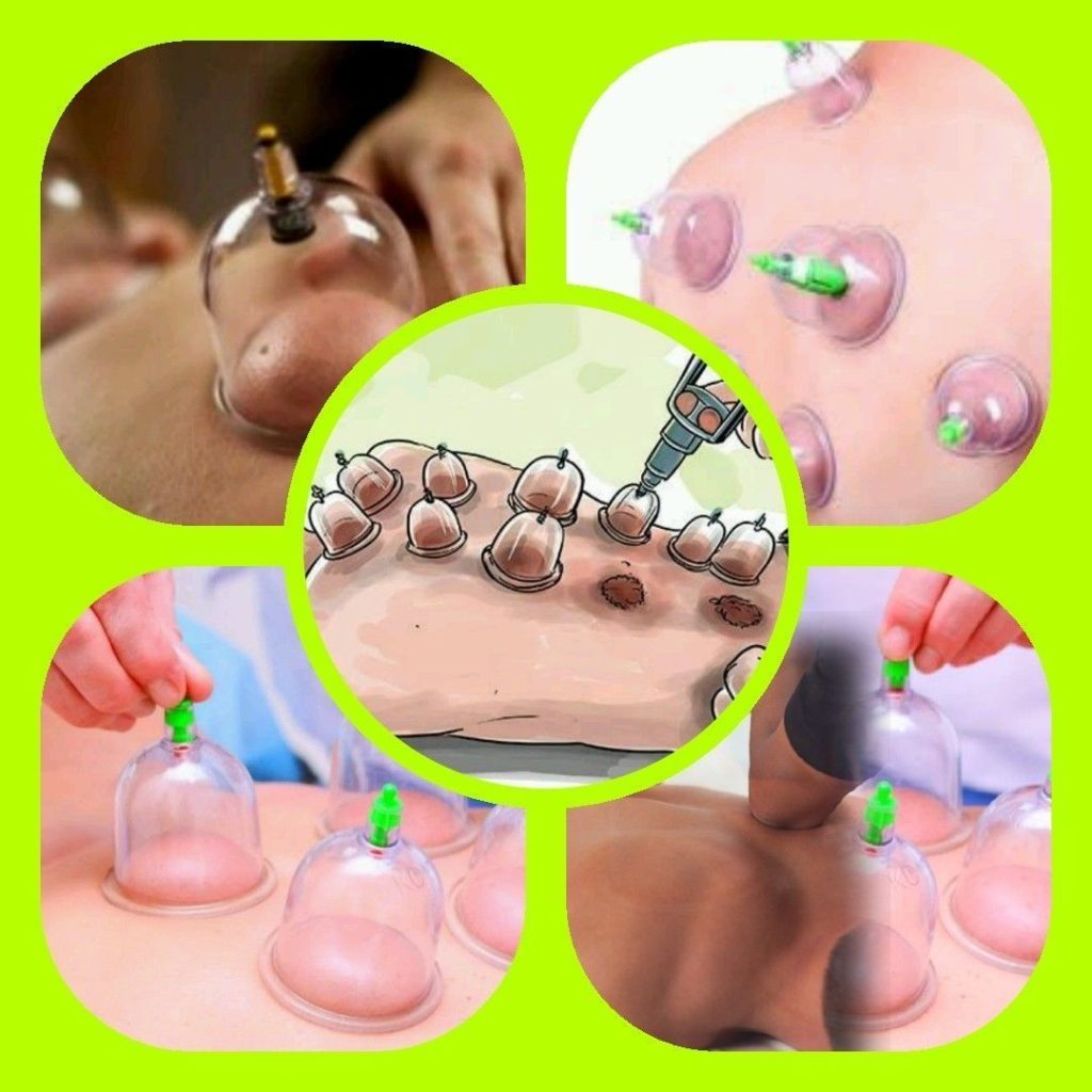 الحجامة المنزلية في الرياض – العلاج الطبيعي في راحة بيتك