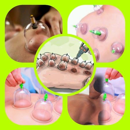 الحجامة المنزلية في الرياض – العلاج الطبيعي في راحة بيتك