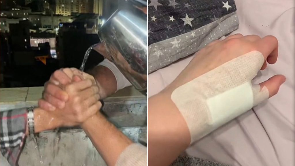 “أحرق يدي لأثبت صداقتي!”.. غضب على المنصات من ترند الماء المغلي