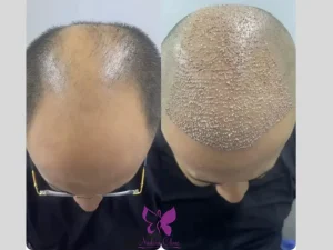 متى تظهر نتائج زراعة الشعر والحواجب؟ وما المتوقع بعد شهرين و6 أشهر؟